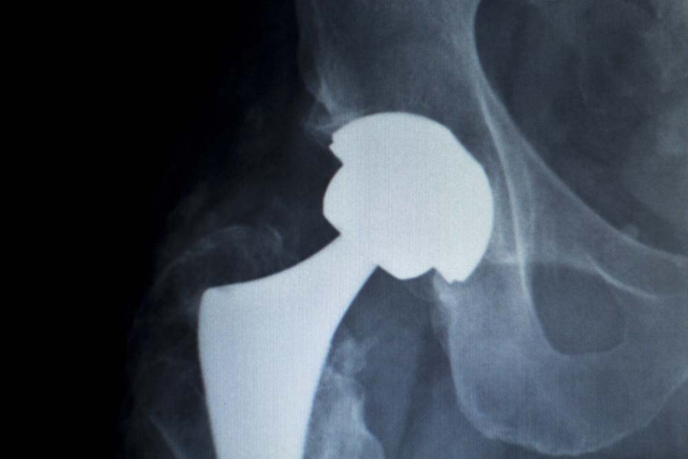 Hip Replacement Xray Scan broken hip and knee replacement care rehabilitation center foresthills queens