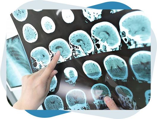 Multiple Sclerosis Doctor checking X-Ray of a patient suffering from multiple sclerosis.