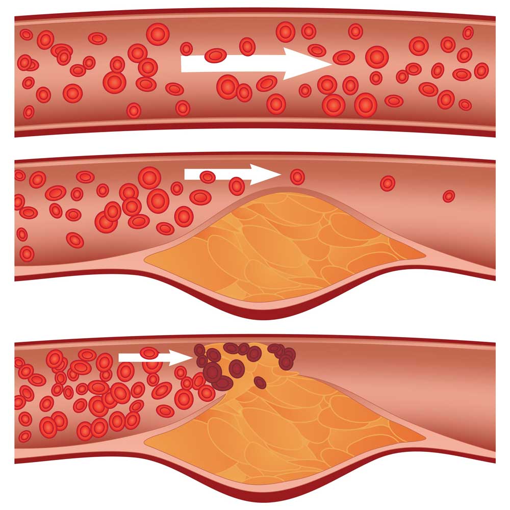 Cholestrol plaque buil-up in arteries visulaization