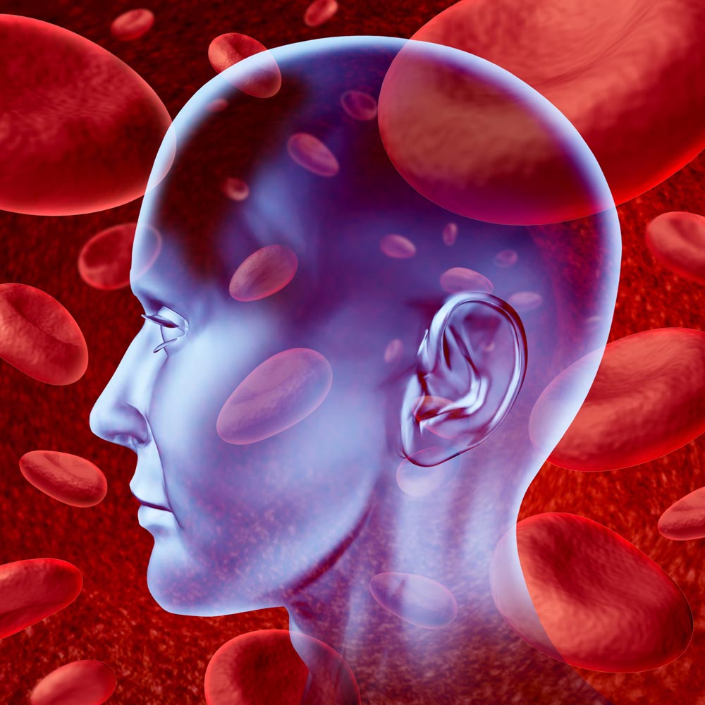 Human brain secondary stroke blood clotting visualization