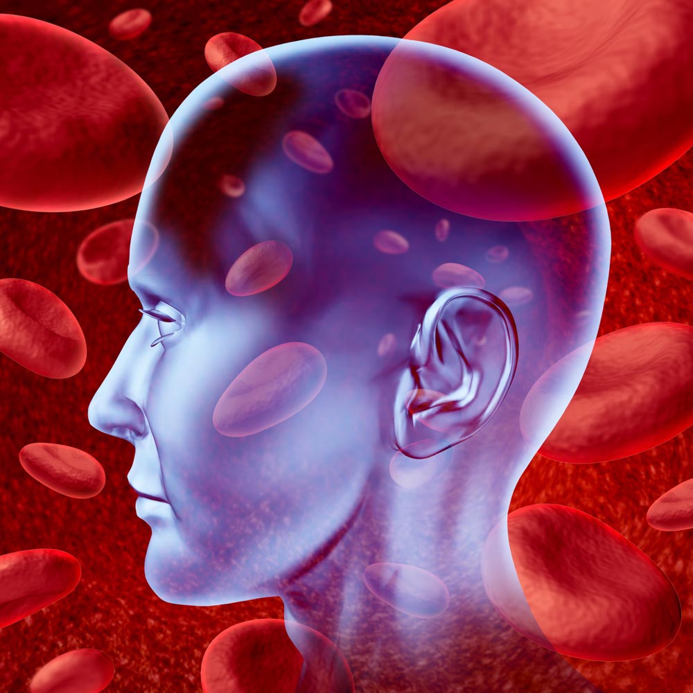 Secondary stroke Human brain secondary stroke blood clotting visualization