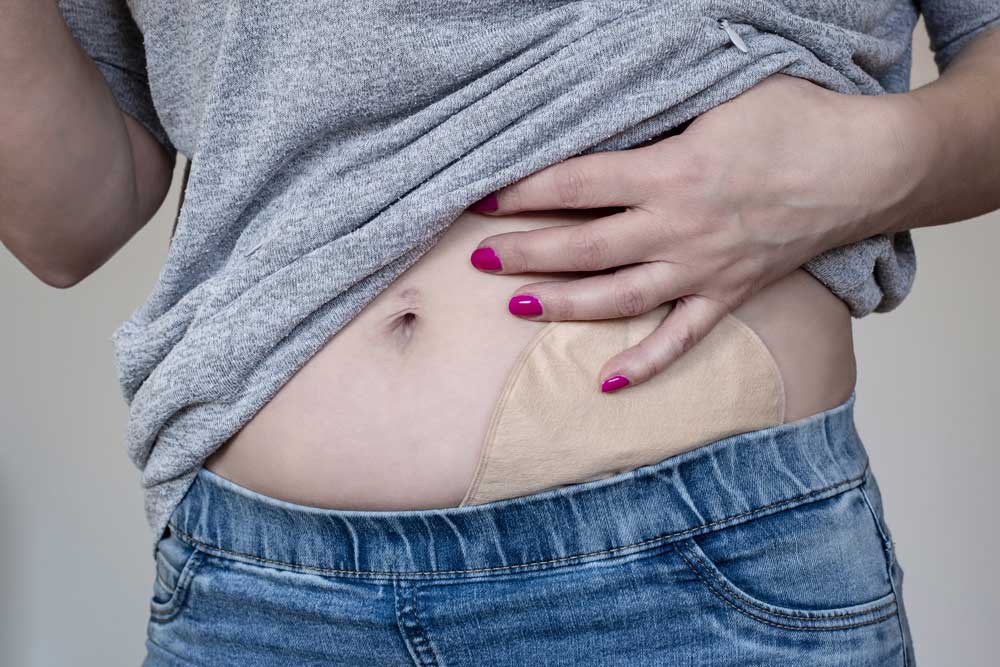 Ileostomy Care Front view on colostomy pouch in skin color attached to woman