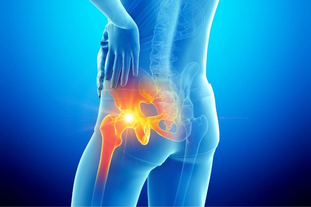 3D medical illustration showing highlighted inflammation in the hip joint area, representing hip pain and discomfort.
