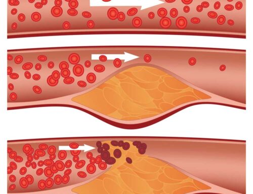 2 Foods That Damage Arteries – See What Happens